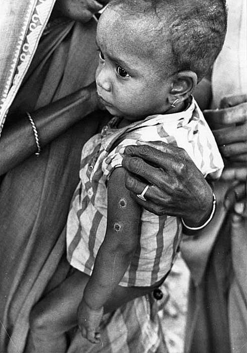 1965 Bangladesh. Child with two rotary lancet sites