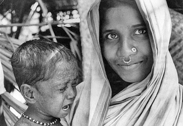 1975 Bangladesh. Rahima Basu, last case in Bangladesh and Asia