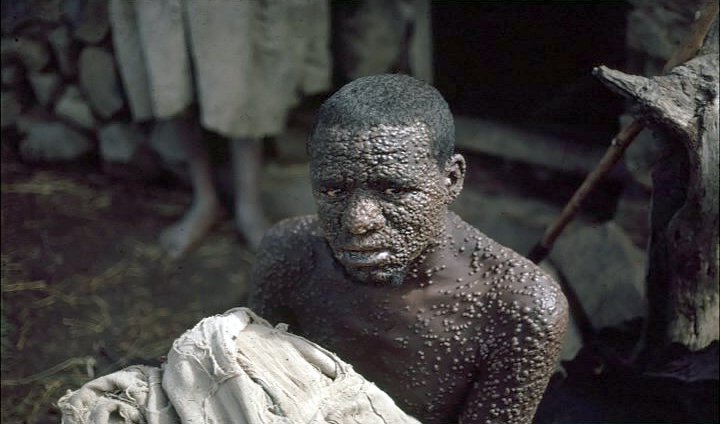 1972 Ethiopia. Smallpox case