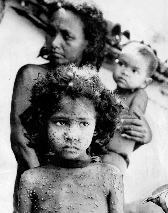 1974 India. Child with smallpox