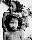 1974 India. Child with smallpox
