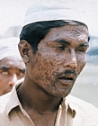 India. Scarring and blindness