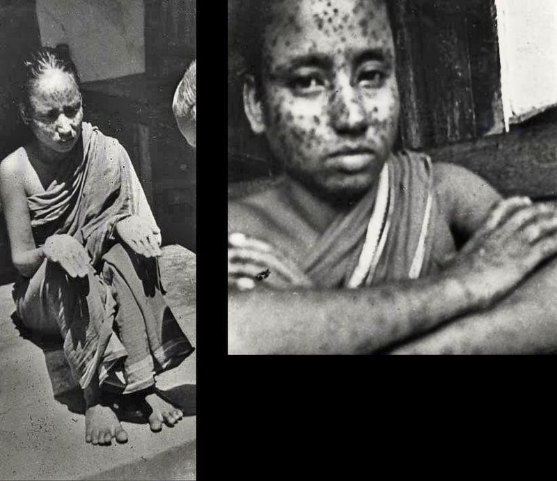 1975 India. Saiban Bibi, last case in India